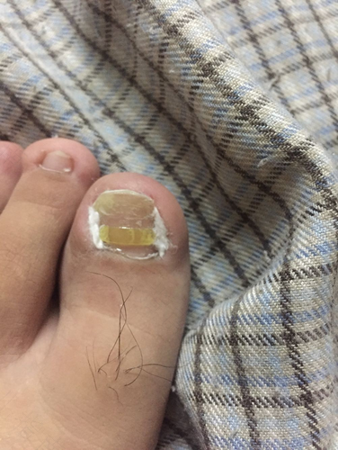 甲沟炎用碘伏行吗 甲沟炎用碘伏行吗