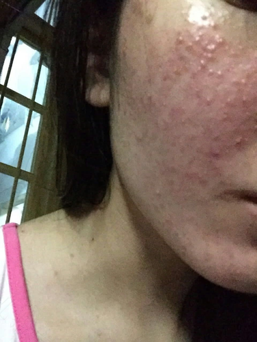 脸上发红痛是怎么回事 脸上发红痛是怎么回事