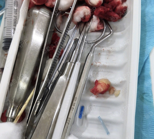 拔牙打麻药打多了会怎么样 拔牙打麻药打多了会怎么样