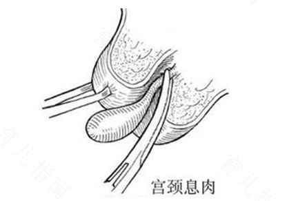 宫颈管内有息肉的症状 宫颈管内有息肉的症状