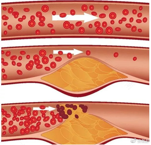 得了脑动脉硬化怎么办 得了脑动脉硬化怎么办