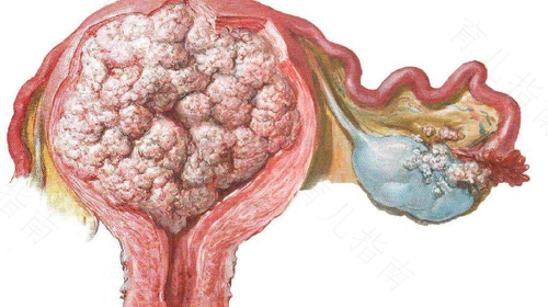 子宫癌是什么引起的? 子宫癌是什么引起的?