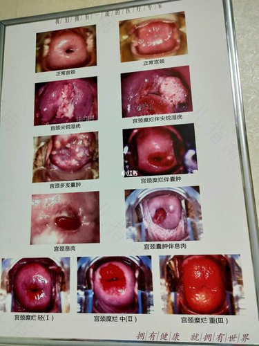 宫颈糜烂临床上分为哪三型 宫颈糜烂临床上分为哪三型
