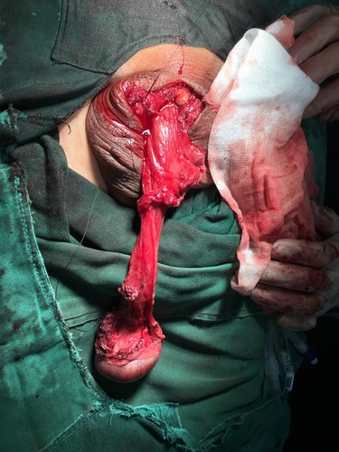 传统鞘膜积液手术后多久能恢复好 传统鞘膜积液手术后多久能恢复好