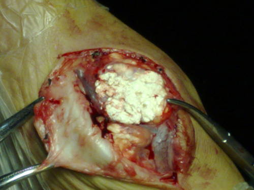 痛风永远不能根治吗 痛风永远不能根治吗