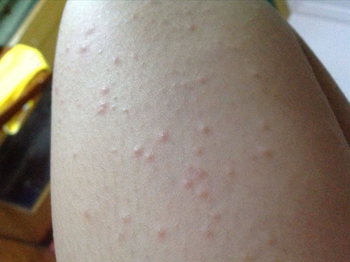 过敏可以用热水洗澡吗