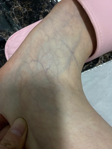 脚有旧伤疼起来怎么办 脚有旧伤疼起来怎么办