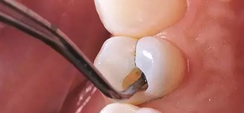 所有大牙都坏了怎么办