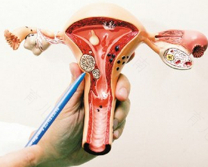 子宫左侧有囊肿怎么办大约6mm 子宫左侧有囊肿怎么办大约6mm