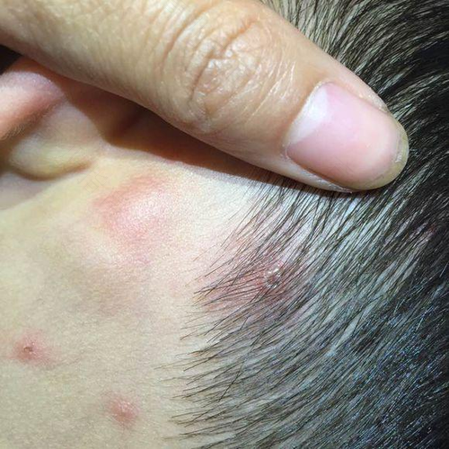 水痘会长在头皮上怎么办