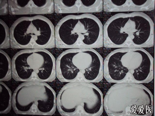 咳嗽的右胸疼是怎么回事 咳嗽的右胸疼是怎么回事