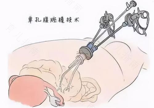 做完腹腔镜多久会来月经