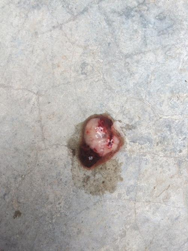 做完人流四天肚子疼正常吗 做完人流四天肚子疼正常吗