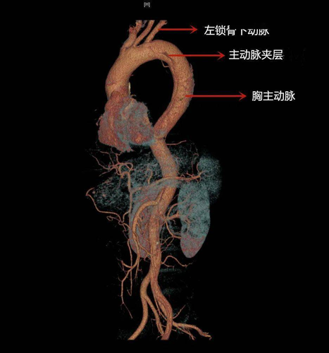 什么会引起主动脉剥离血管堵塞 什么会引起主动脉剥离血管堵塞