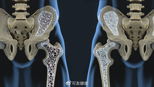 髋关节弹响 髋关节弹响