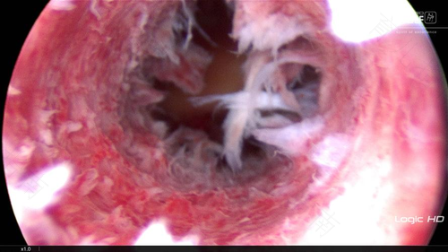 宫颈息肉一定要做手术吗 宫颈息肉一定要做手术吗