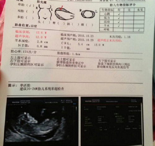 不是典型的多囊要不要治疗 不是典型的多囊要不要治疗