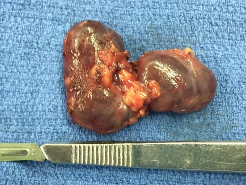 宫颈纳囊是怎么引起的 宫颈纳囊是怎么引起的