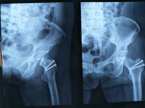 小儿髋关节半脱位的表现 小儿髋关节半脱位的表现