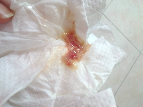 吸烟喉咙里老是有痰怎么办 吸烟喉咙里老是有痰怎么办