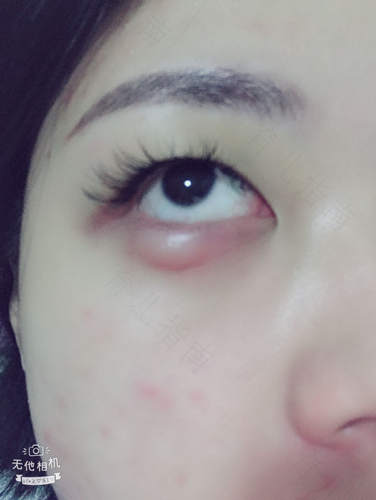 眼睛下面肿怎么回事 眼睛下面肿怎么回事