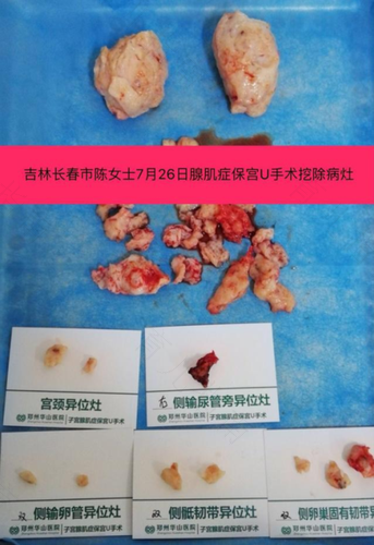 子宫腺肌瘤是什么病严重吗 子宫腺肌瘤是什么病严重吗