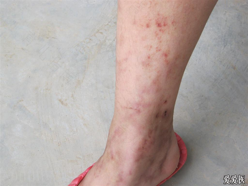 皮肤溃疡怎么办才好得快 皮肤溃疡怎么办才好得快