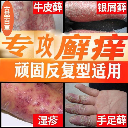 阴囊湿疹可以洗澡吗? 阴囊湿疹可以洗澡吗?