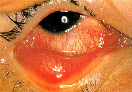 结膜炎痒是快好了吗 结膜炎痒是快好了吗