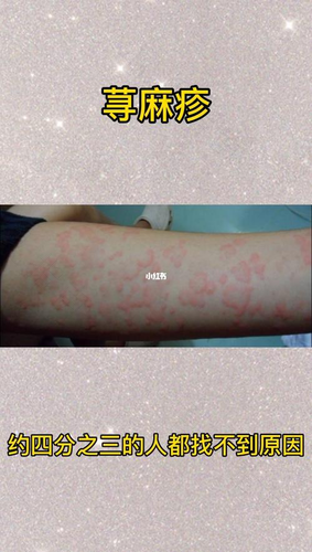 过敏荨麻疹会传染吗 过敏荨麻疹会传染吗