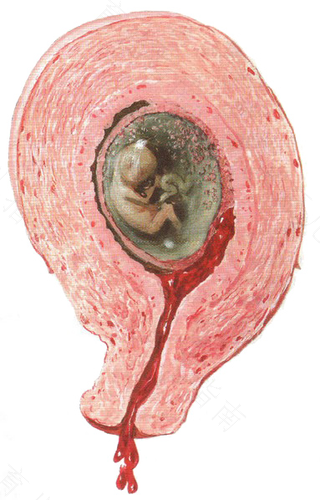 宫颈息肉引起出血是癌变了吗 宫颈息肉引起出血是癌变了吗