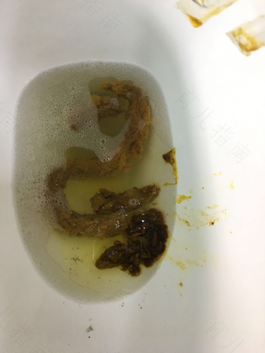 胃反流大便黑怎么办 胃反流大便黑怎么办