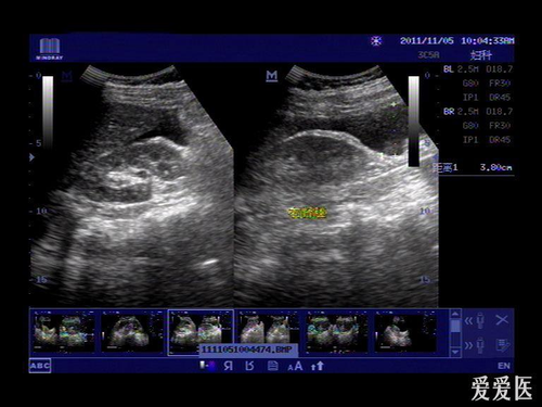 宫外孕40天会破裂吗