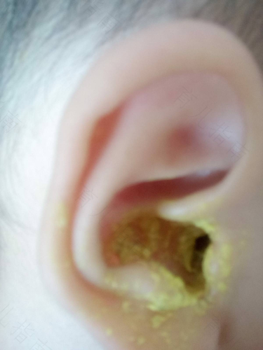 耳朵脸蛋通红怎么回事 耳朵脸蛋通红怎么回事