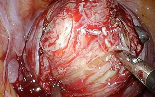 子宫后壁肌瘤属于哪种肌瘤 子宫后壁肌瘤属于哪种肌瘤