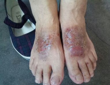 皮炎湿疹怎么治疗好得快 皮炎湿疹怎么治疗好得快