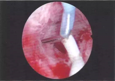 宫颈发红怎么治疗最好 宫颈发红怎么治疗最好