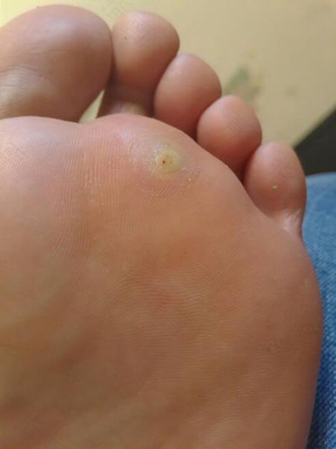 脚上长的跖疣能自愈消退吗