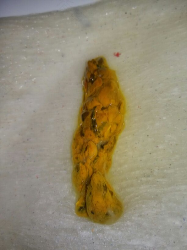 解了大便屁眼疼怎么办 解了大便屁眼疼怎么办