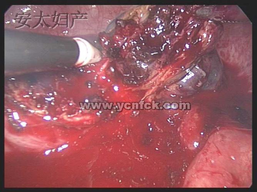 大便时小腹和肛门疼怎么回事 大便时小腹和肛门疼怎么回事