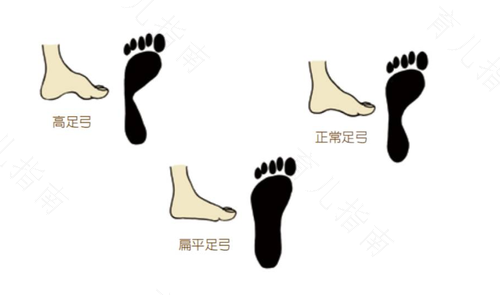 扁平足和正常足的区别图片 扁平足和正常足的区别图片