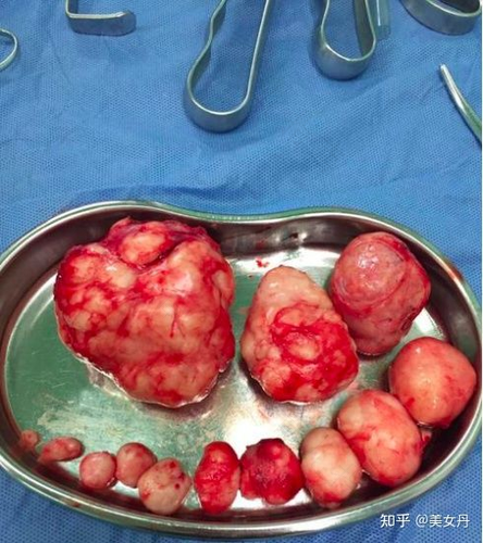 子宫切除和绝经一样吗 子宫切除和绝经一样吗