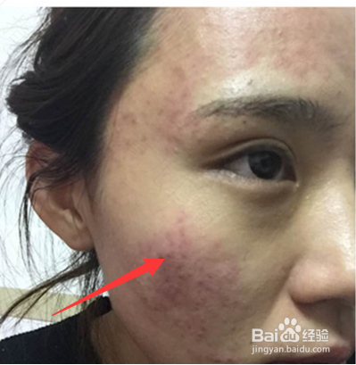 脸上长了湿疹该怎么办 脸上长了湿疹该怎么办