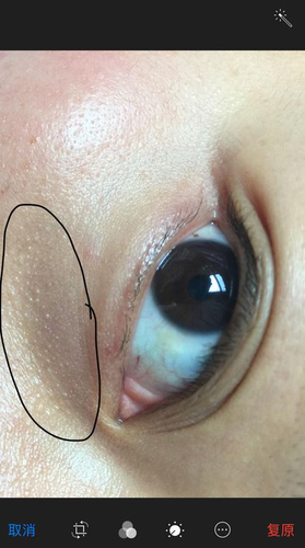 眼睛下面黑点点是什么 眼睛下面黑点点是什么