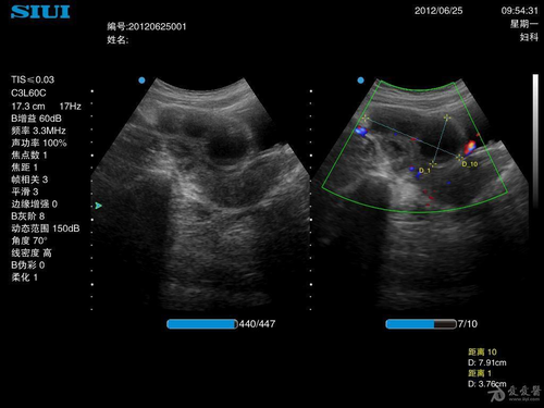 左边输卵管隐隐作痛怎么办 左边输卵管隐隐作痛怎么办