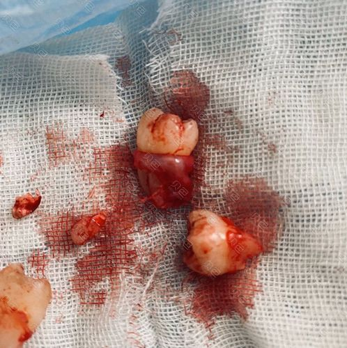 拔智齿最多一次可以拔几颗 拔智齿最多一次可以拔几颗