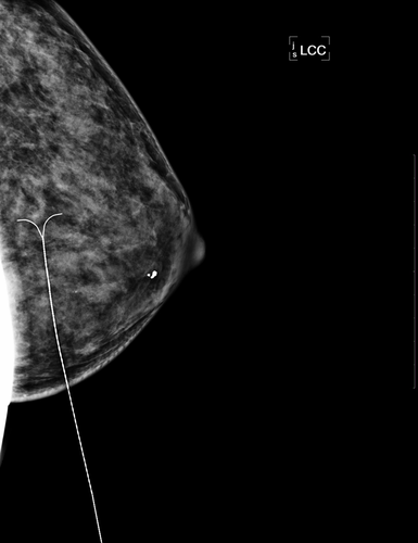 哺乳期乳腺脓肿穿刺多久能好 哺乳期乳腺脓肿穿刺多久能好