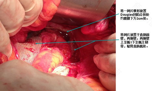子宫脱垂保守治疗方法 子宫脱垂保守治疗方法