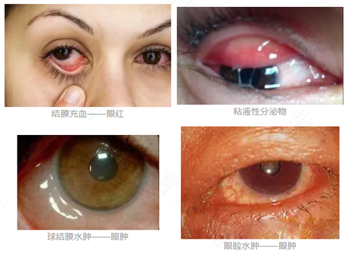 季节性眼睛痒是怎么回事儿?