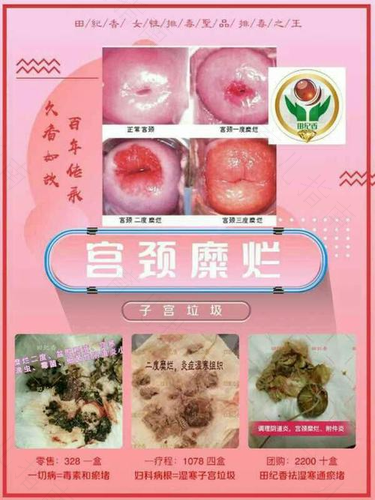 假性和真性宫颈糜烂 假性和真性宫颈糜烂